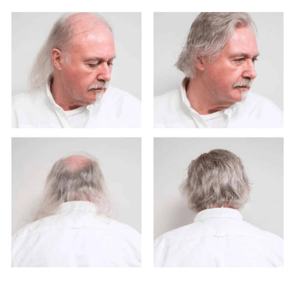 Resultado Benjamín — 8 meses con Método PARC