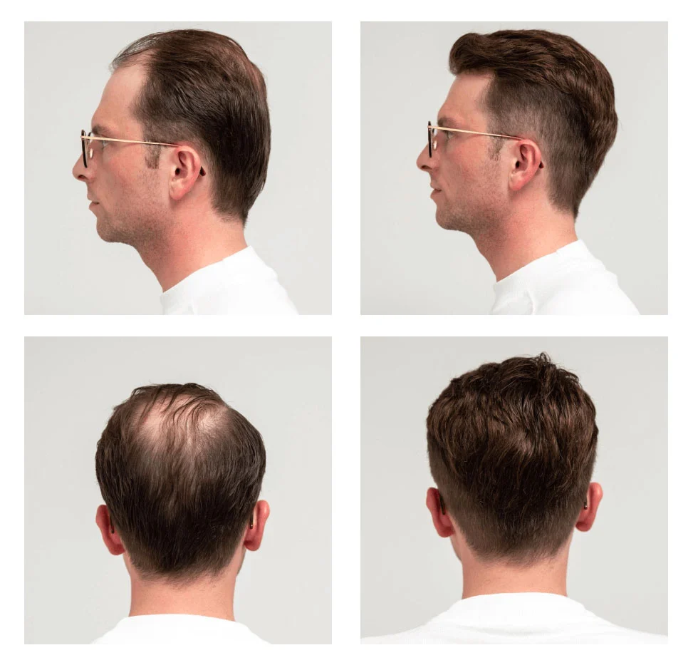 Resultado Tomás — 3 meses con Método PARC